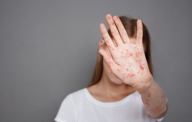 Hand with measles being held up in front of a woman's face