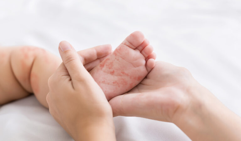 Holding baby's foot with measles