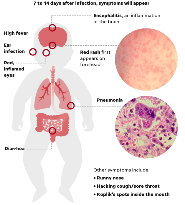 Image demonstrating all of the symptoms caused by the measles