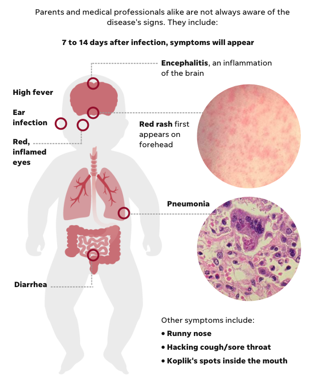 Visual representation of Measles symptoms