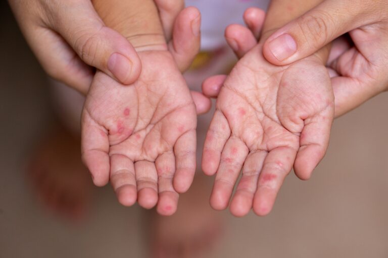 child's hands with measles
